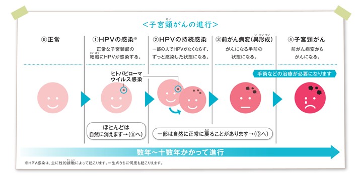 表：子宮頸がんの進行
